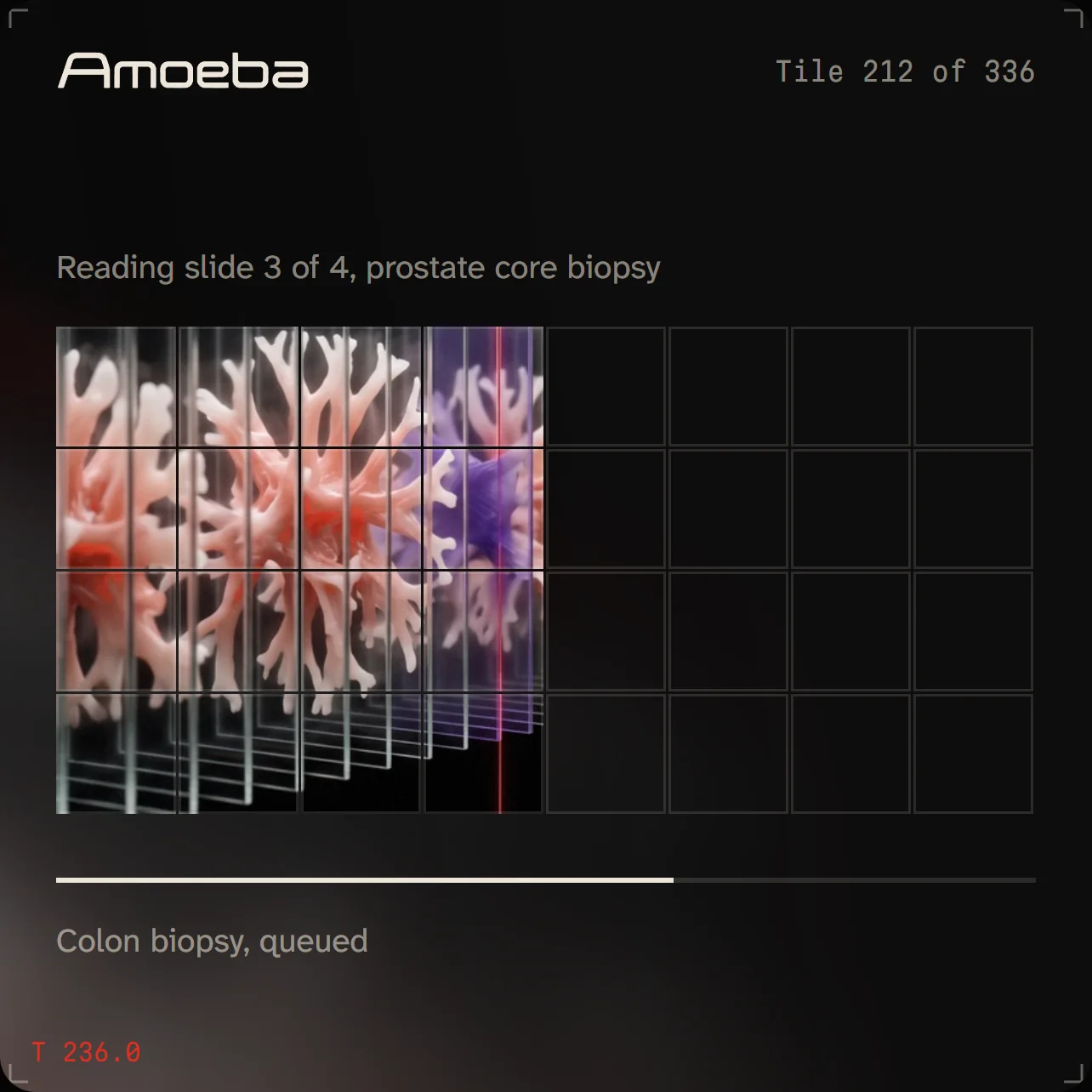Amoeba's case view filling the tile map as it reads a prostate biopsy, then flagging two regions
